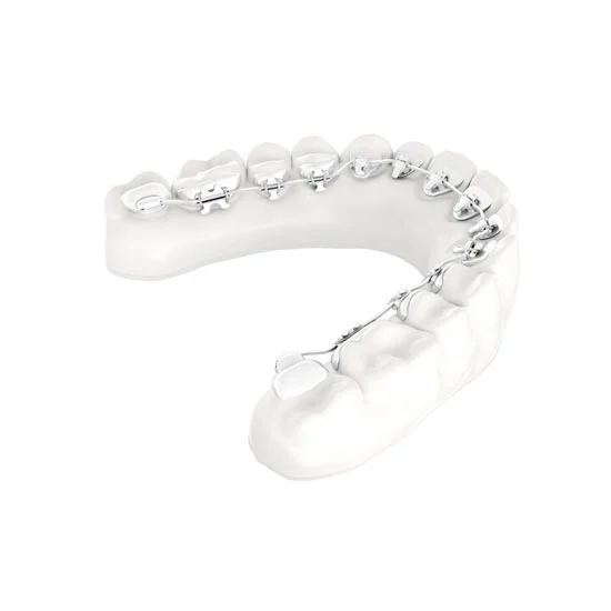 Lingualtechnik Dresden - unsichtbare Zahnspange