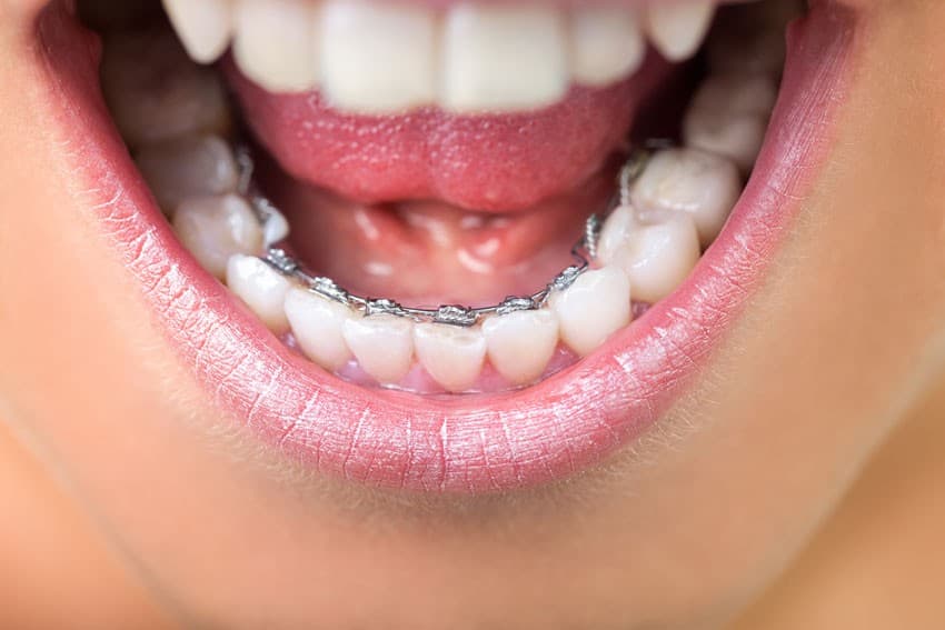 Lingualtechnik Brackets an Zähnen – Nahaufnahme